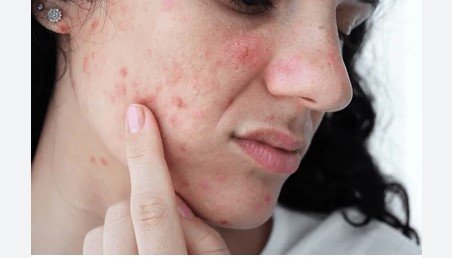 Skin Disorders Increasing Rapidly Among Young Population